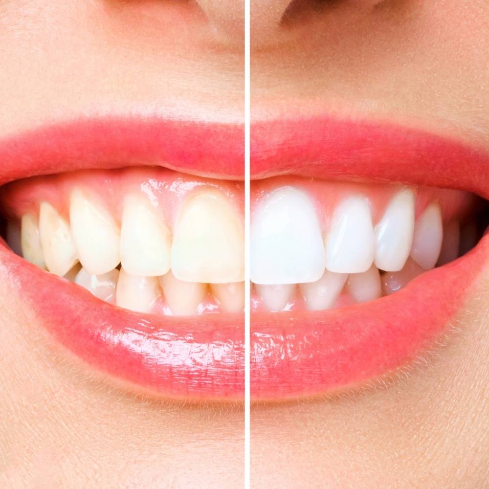 Teeth Whitening Avenue Dental Surgery